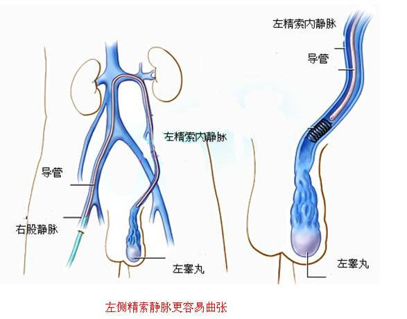 精索靜脈曲張手術費用